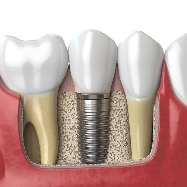 Dental Implants link
