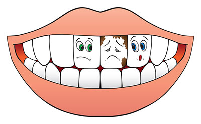 This is the image for the news article titled Preventing Tooth Decay